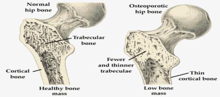 KADINLARDA KEMİK ERİMESİ (Osteoporoz)